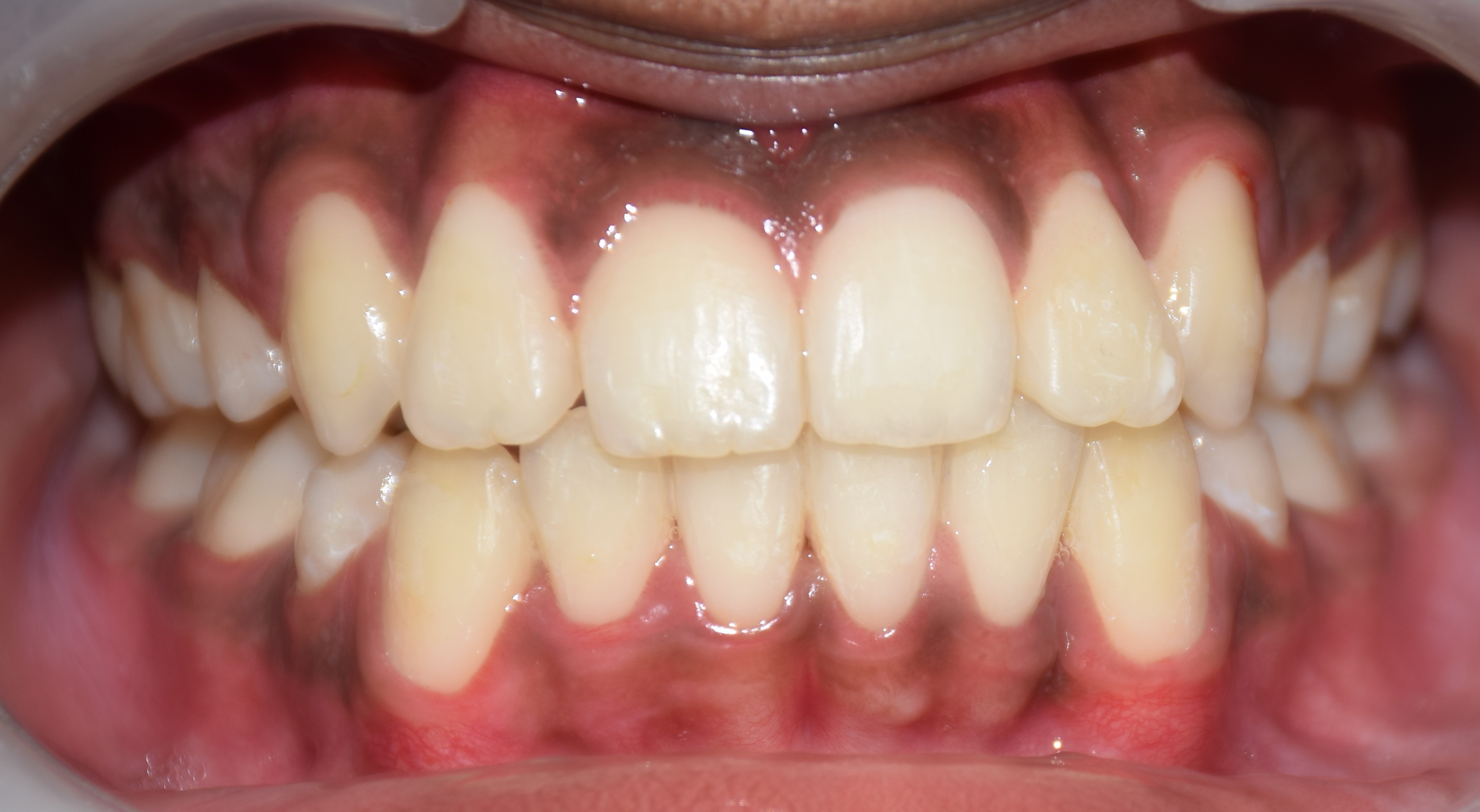 ORTHODONTIC TREWATMENT — after treatment